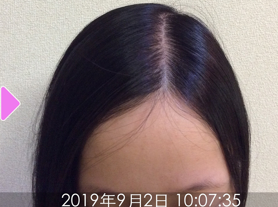 30代女性 発毛症例 No 10 お客様発毛症例 スーパースカルプ発毛センター 仙台泉店
